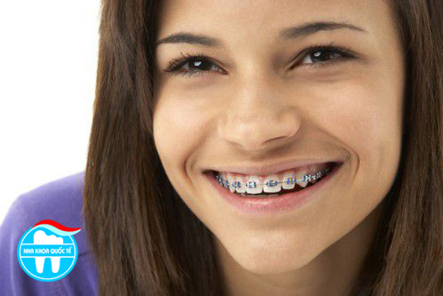 Những đều cần biết về chỉnh hình răng miệng