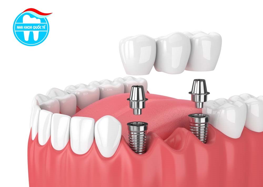 Trồng răng Implant bạn cần biết những gì?