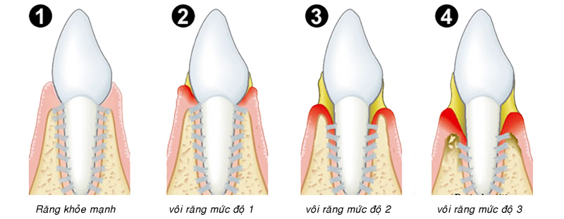 cạo vôi răng