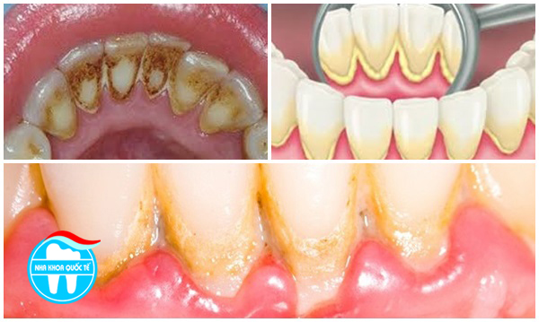 cạo vôi răng