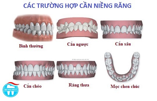 chi phí niềng răng