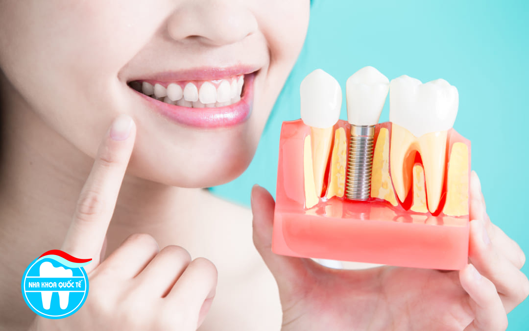 chi phí trồng răng implant
